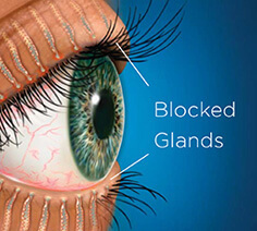Blocked Glands